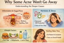 Why Acne Persists